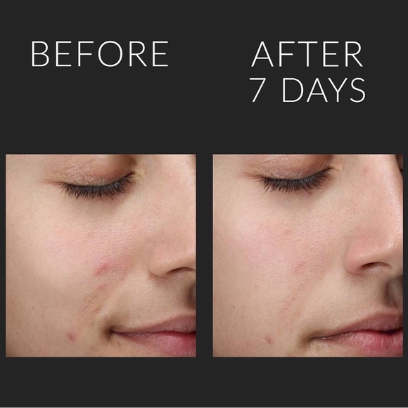 Kate Somerville Liquid Exfolikate - Picture 3 of 3